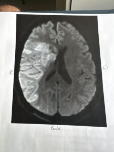 Craniotomy Stroke Recovery